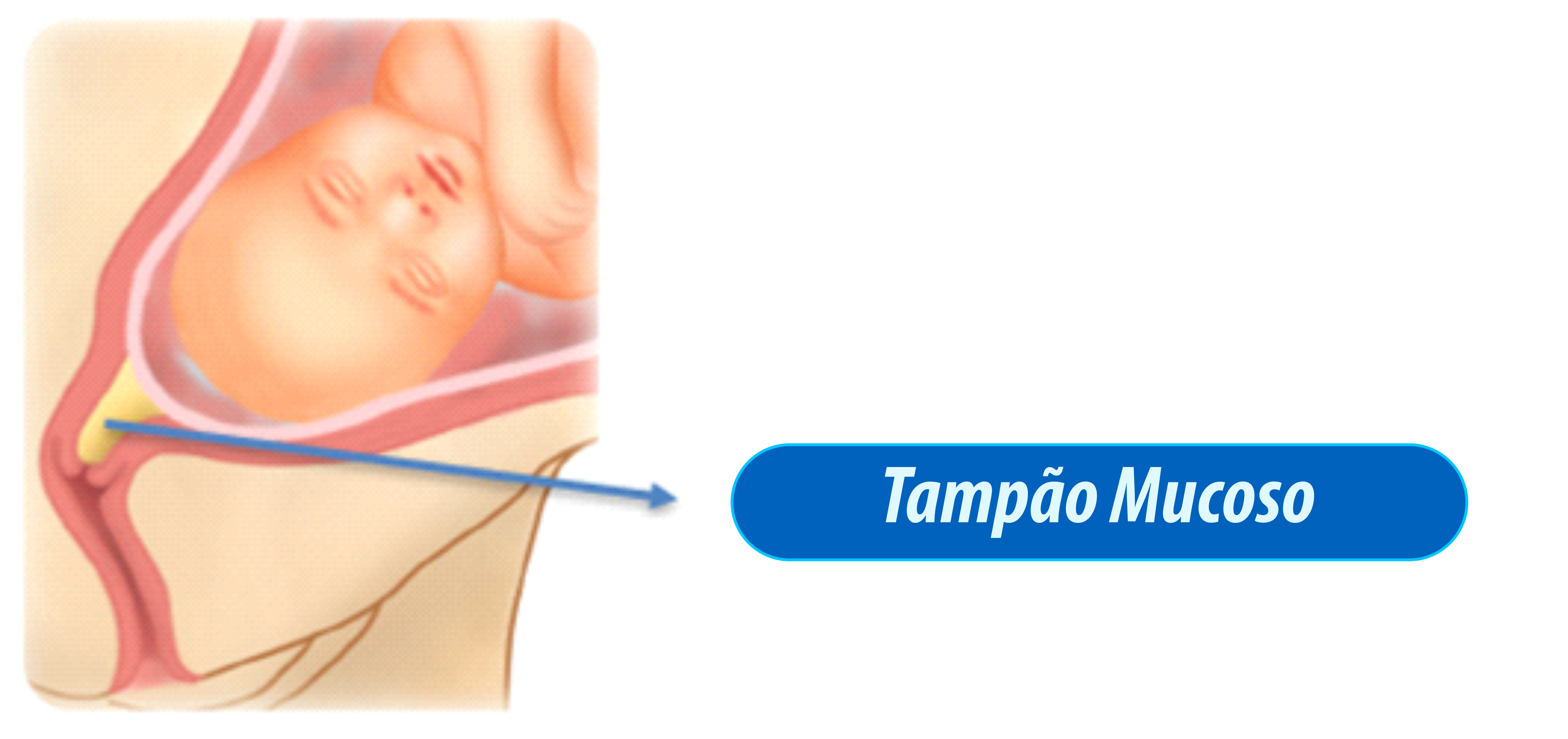 Tampão mucoso 1